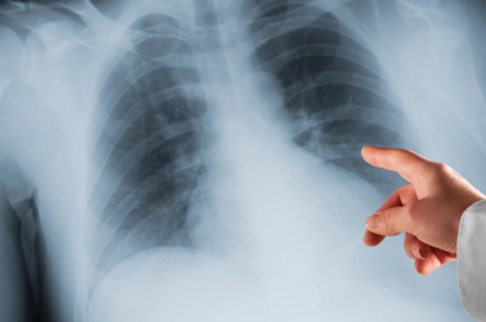 Bacterial pneumonia – causes, side effects and treatments at
