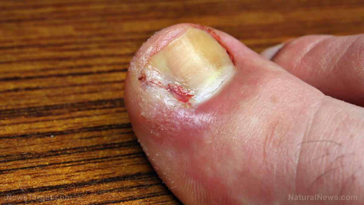 can a fungal infection look like eczema