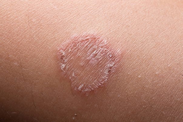 Tinea corporis – causes, side effects and treatments at 